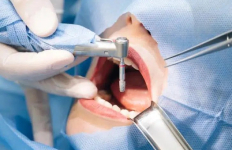 During Surgery
