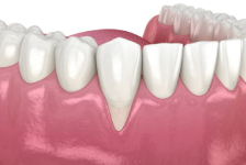 Gum Surgery