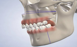 Jaw Surgery