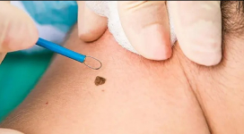 Lesion Removal
