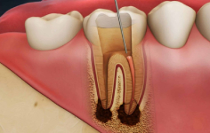 Root Canal Surgery