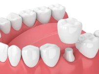 Tooth Extraction