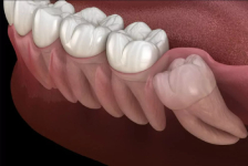 Wisdom Tooth Removal